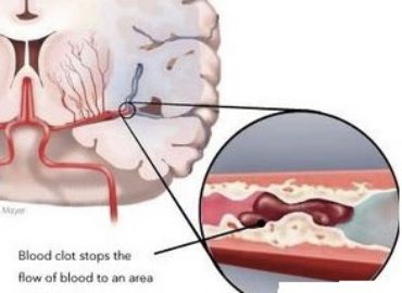 Stroke Treatment