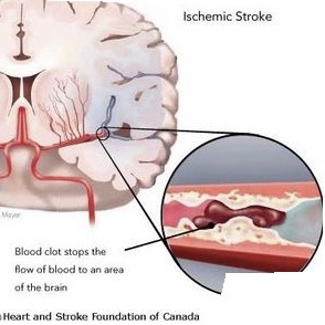 Stroke Treatment